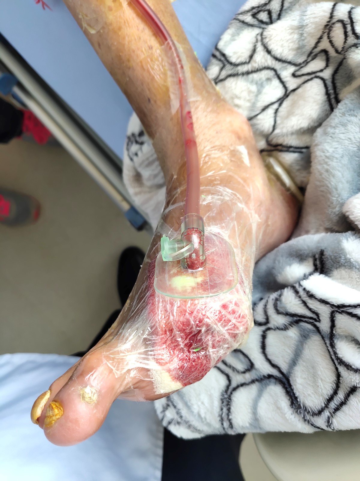 出院前换药:用生理盐水及康复新液清洁伤口 普朗特湿敷10分钟 生长