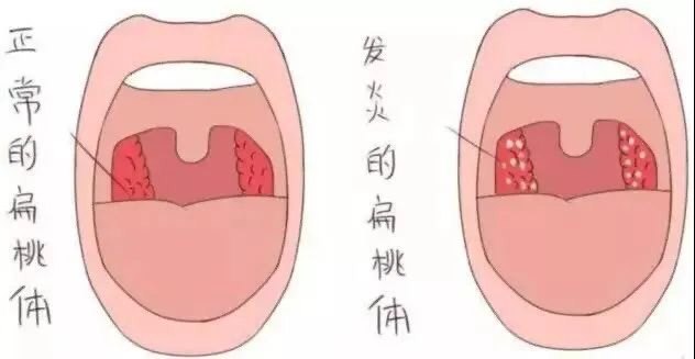 扁桃体是人体的守卫or叛徒 急性扁桃体炎
