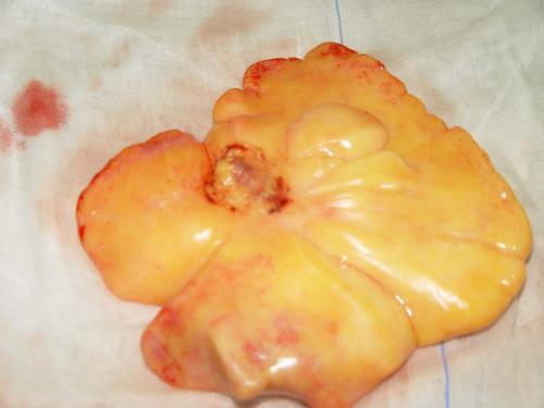 粘液样脂肪肉瘤图片图片