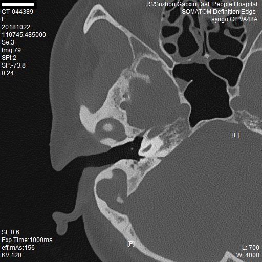 ct片显示中耳胆脂瘤破坏周围骨质及听小骨术中取出的胆脂瘤组织怎样
