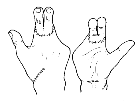 断指再植_治疗介绍_费用 - 好大夫在线