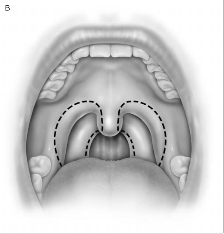 腭咽弓宽,与悬雍垂顶部相连,口咽明显狭窄2,3治疗咽腔明显宽敞了