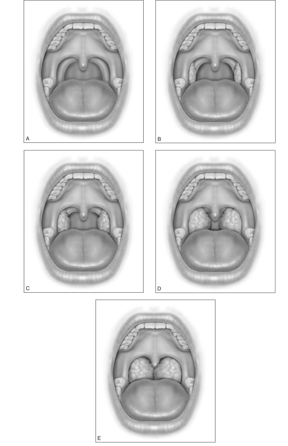 1,扁桃体肥大,下面是扁桃体分度,当3度,4度时口咽部非常狭窄了