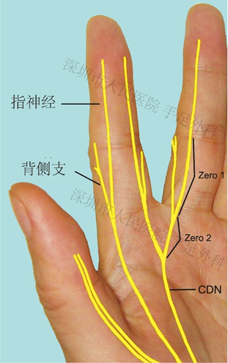特色技术—手指神经修复的分支转位术