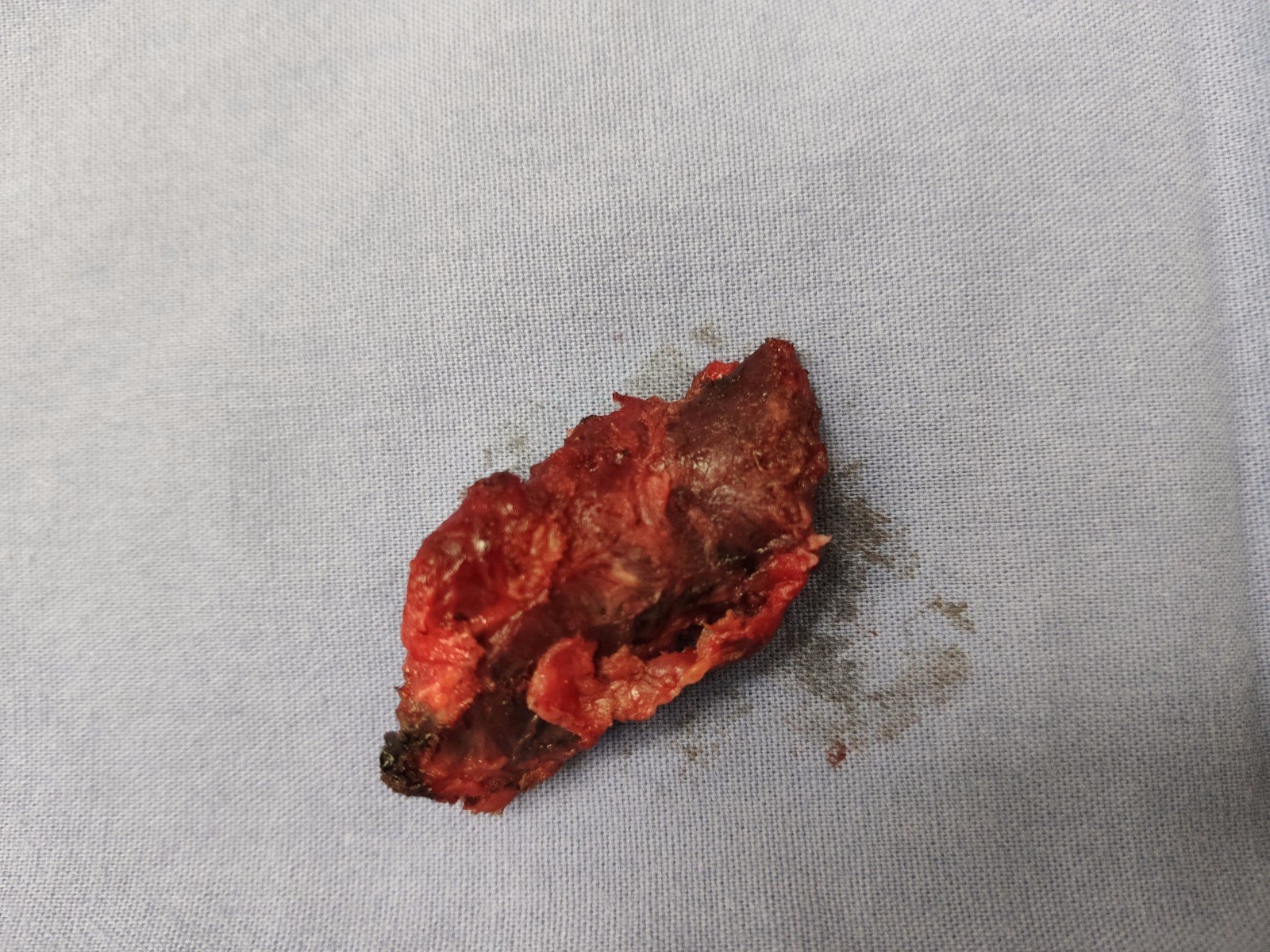 腔鏡下甲狀腺手術適合人群:(1)實性甲狀腺腫瘤,腫瘤直徑小於5cm