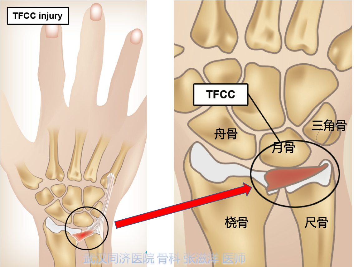 手腕部疼痛 不能使劲 医生说是tfcc 三角纤维软骨复合体损伤是什么意思 关节损伤 好大夫在线