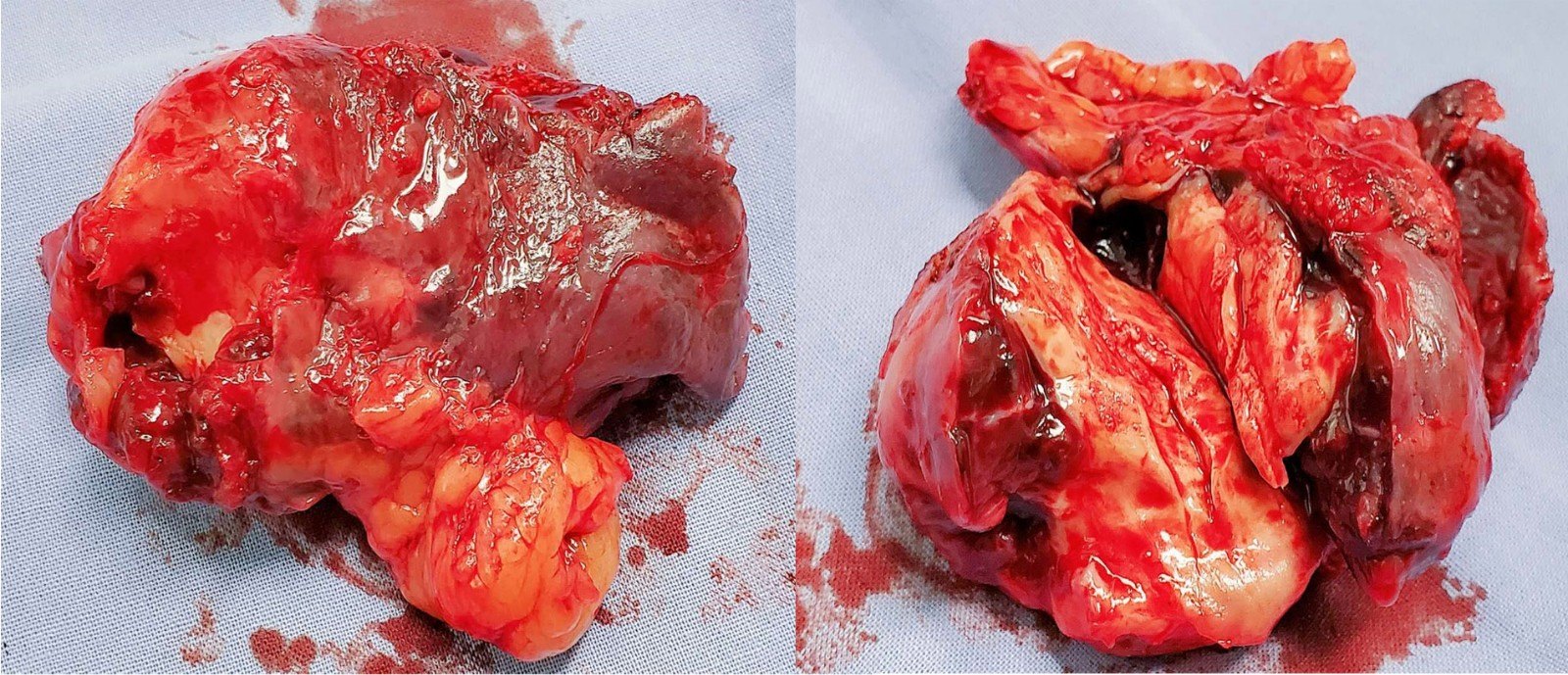 脾臟良性腫瘤或低度惡性腫瘤必須切除整個脾臟嗎其實還可以選擇保留