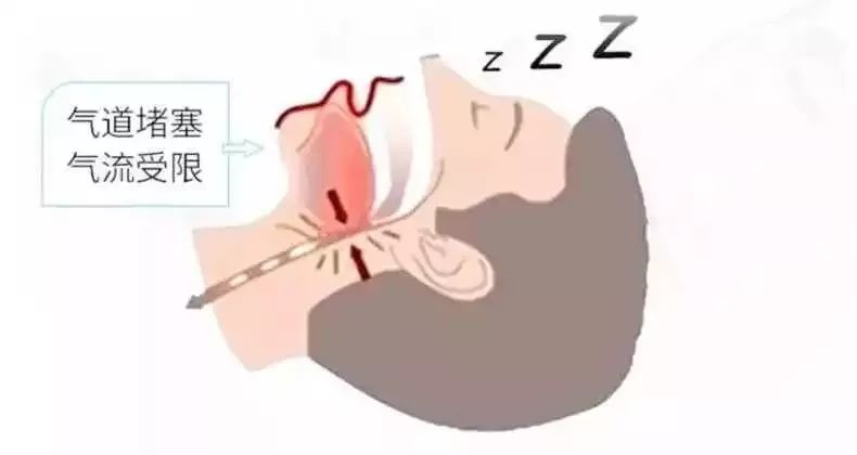 但是肥胖兒常伴有扁桃體或腺樣體增生和肥大,導致上氣道梗阻狹窄,一旦