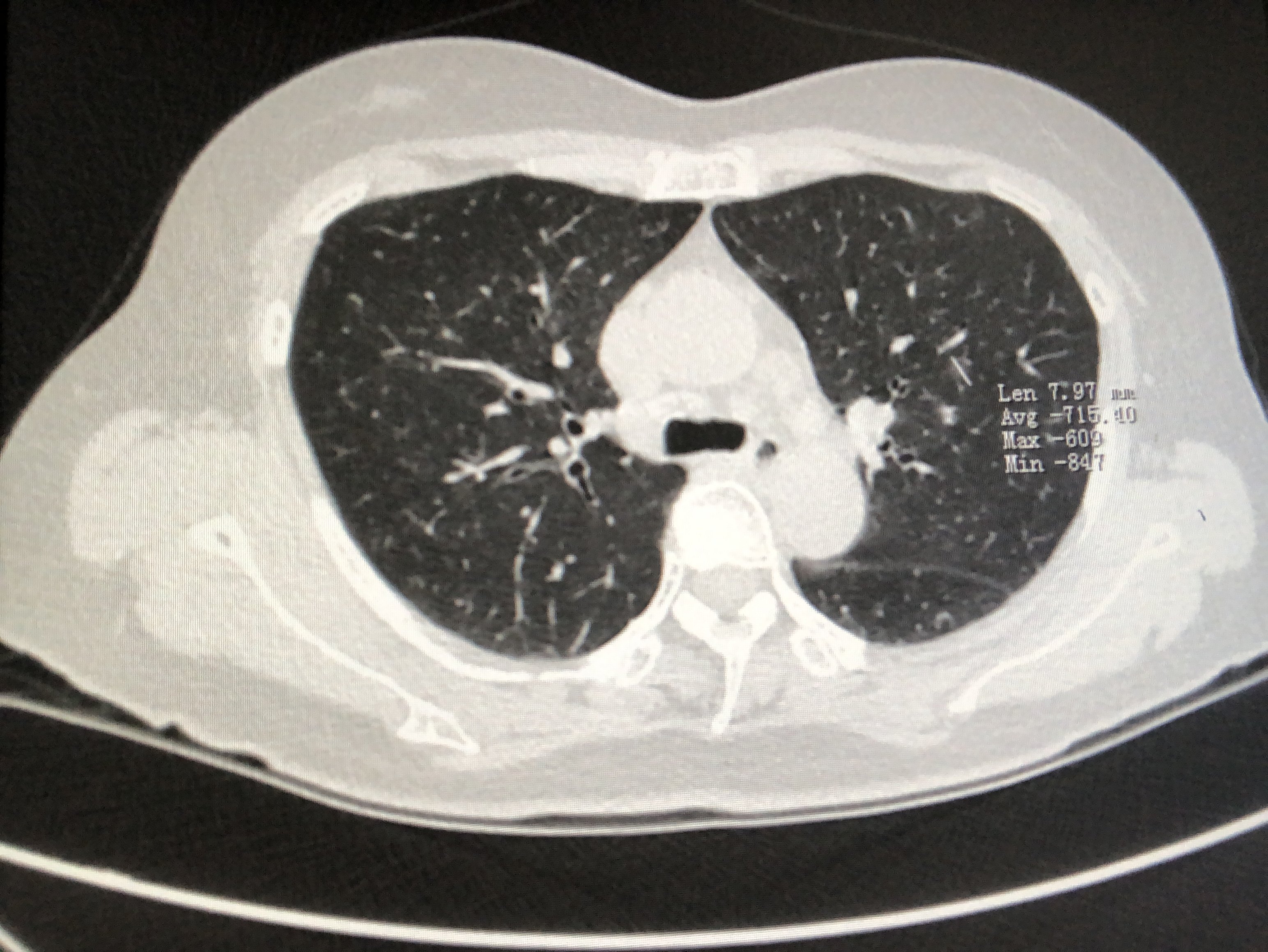 肺部结节图片查看图片