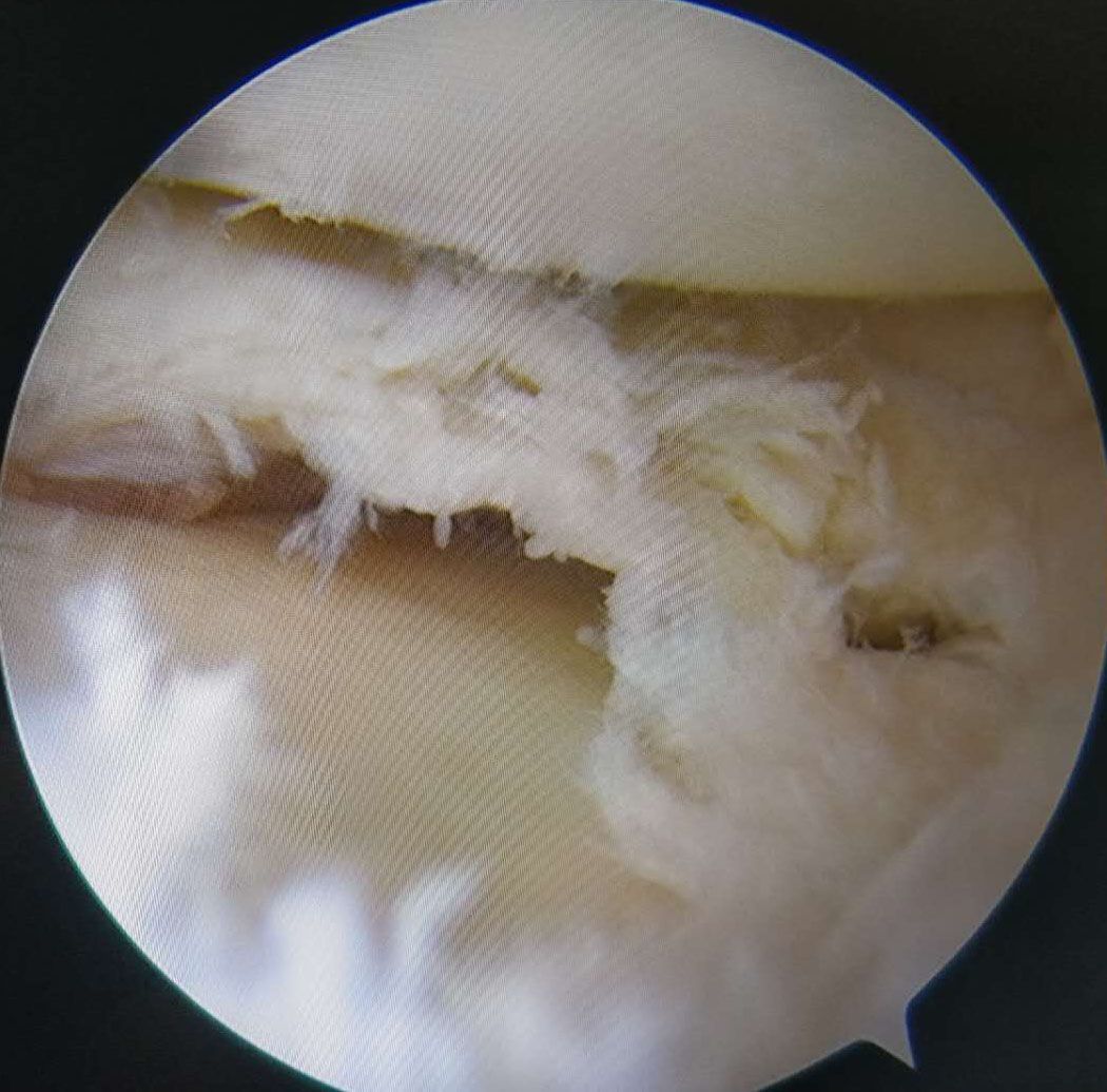 膝关节内侧半月板损伤图片