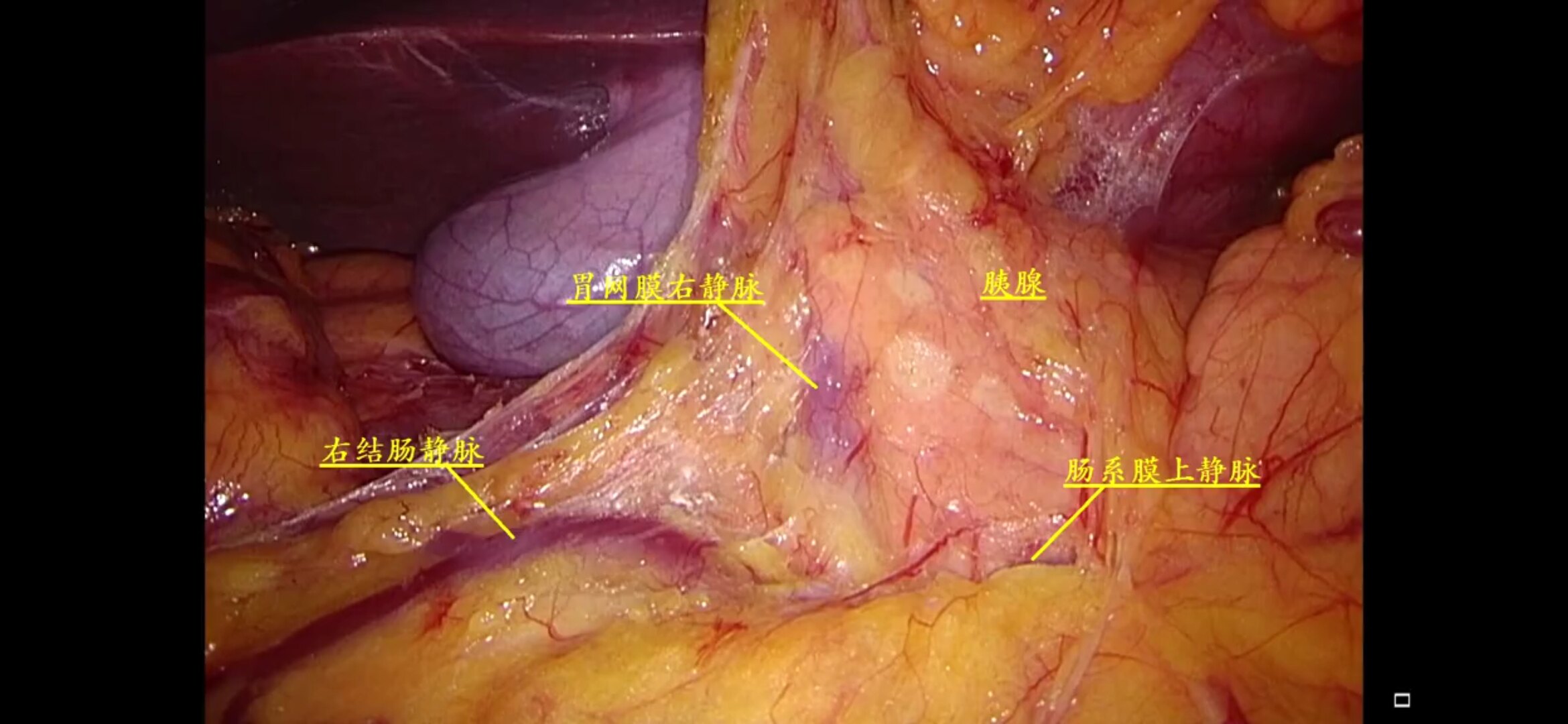 腹腔镜下结肠癌根治术 - 好大夫在线