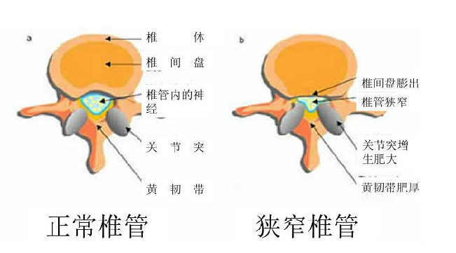 腰椎管狭窄图解图片