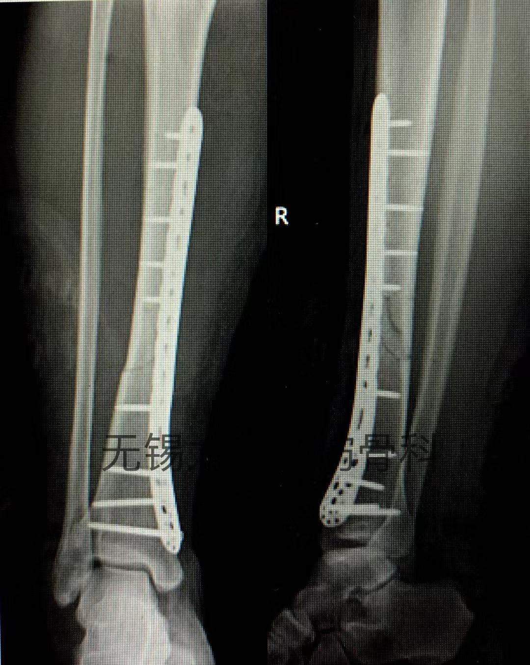 mipo技術微創治療脛骨中下段骨折_脛腓骨骨折_脛腓骨骨折治療方式