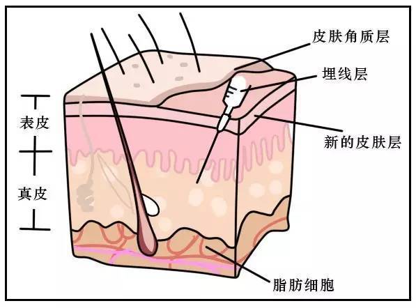 埋线治疗颈椎病的原理_太极拳治疗颈椎病的原理