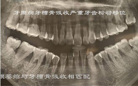 如何有效预防牙龈萎缩 附照片 牙龈萎缩 牙龈萎缩预防
