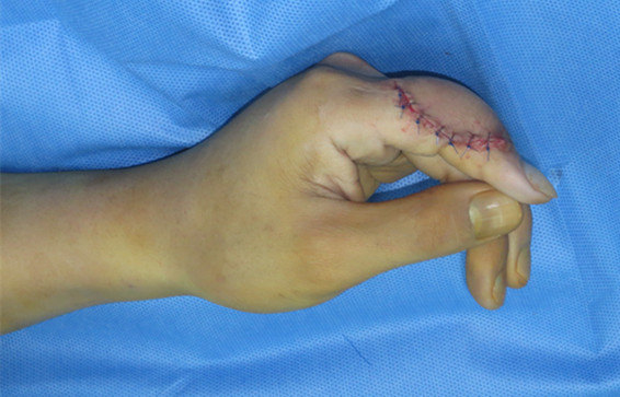 手指关节粗大整形手术图片