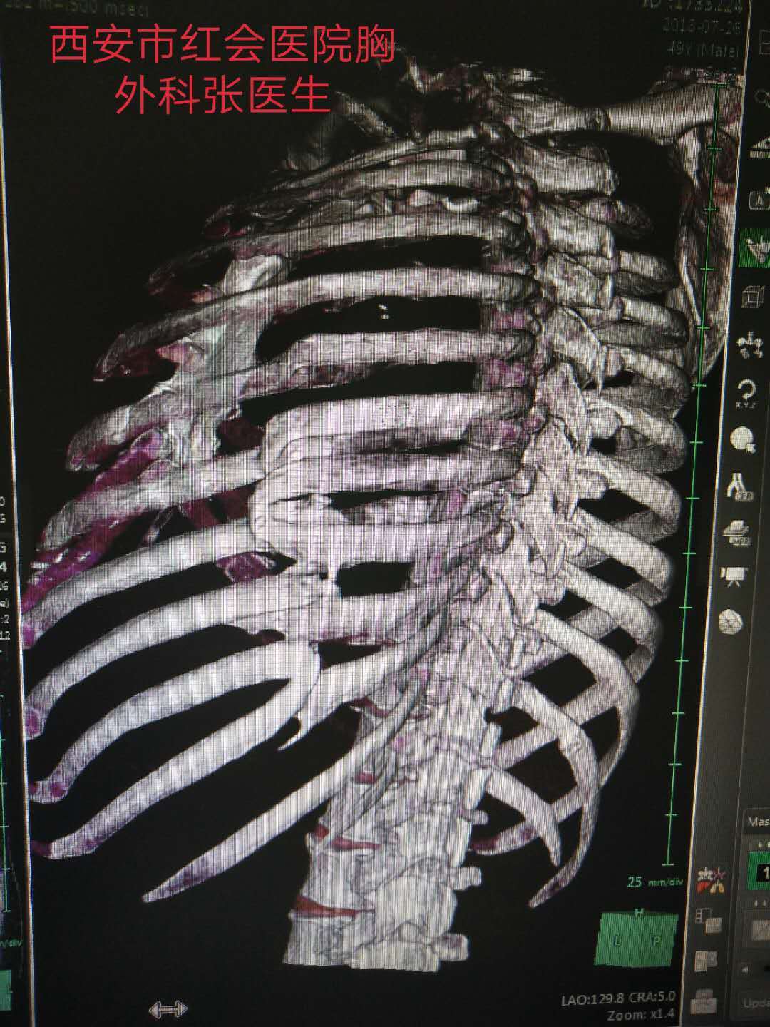 颈肋畸形图片