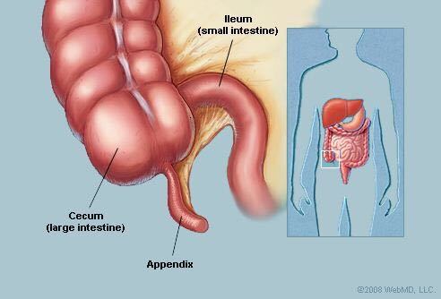 阑尾炎解剖位置图片