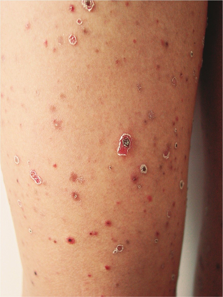 银屑病_疾病介绍_病因_症状_治疗方法_介绍_发病原因_症状表现_至疗