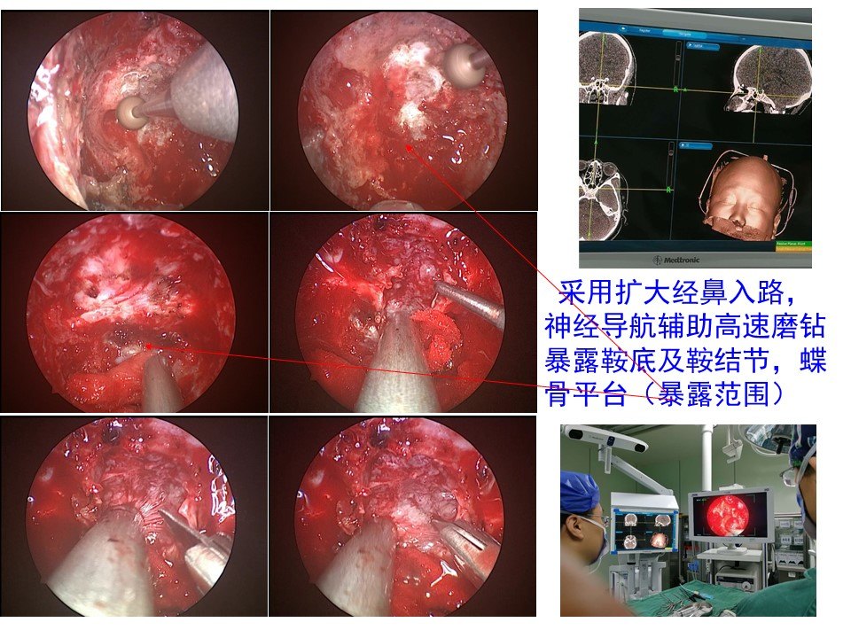 神經導航輔助內鏡擴大經鼻入路切除蝶竇氣化不良鞍結節腦膜瘤 - 好