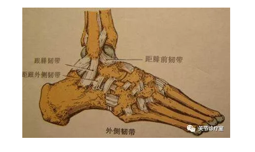 总也好不了的踝扭伤——前距腓韧带损伤 
