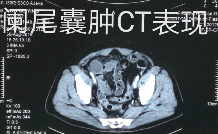 腹膜假黏液瘤病例 17 右下腹囊肿伴有腹腔广泛转移 好大夫在线 腹膜假黏液瘤病例 17 右下腹囊肿伴有腹腔广泛转移 好大夫在线