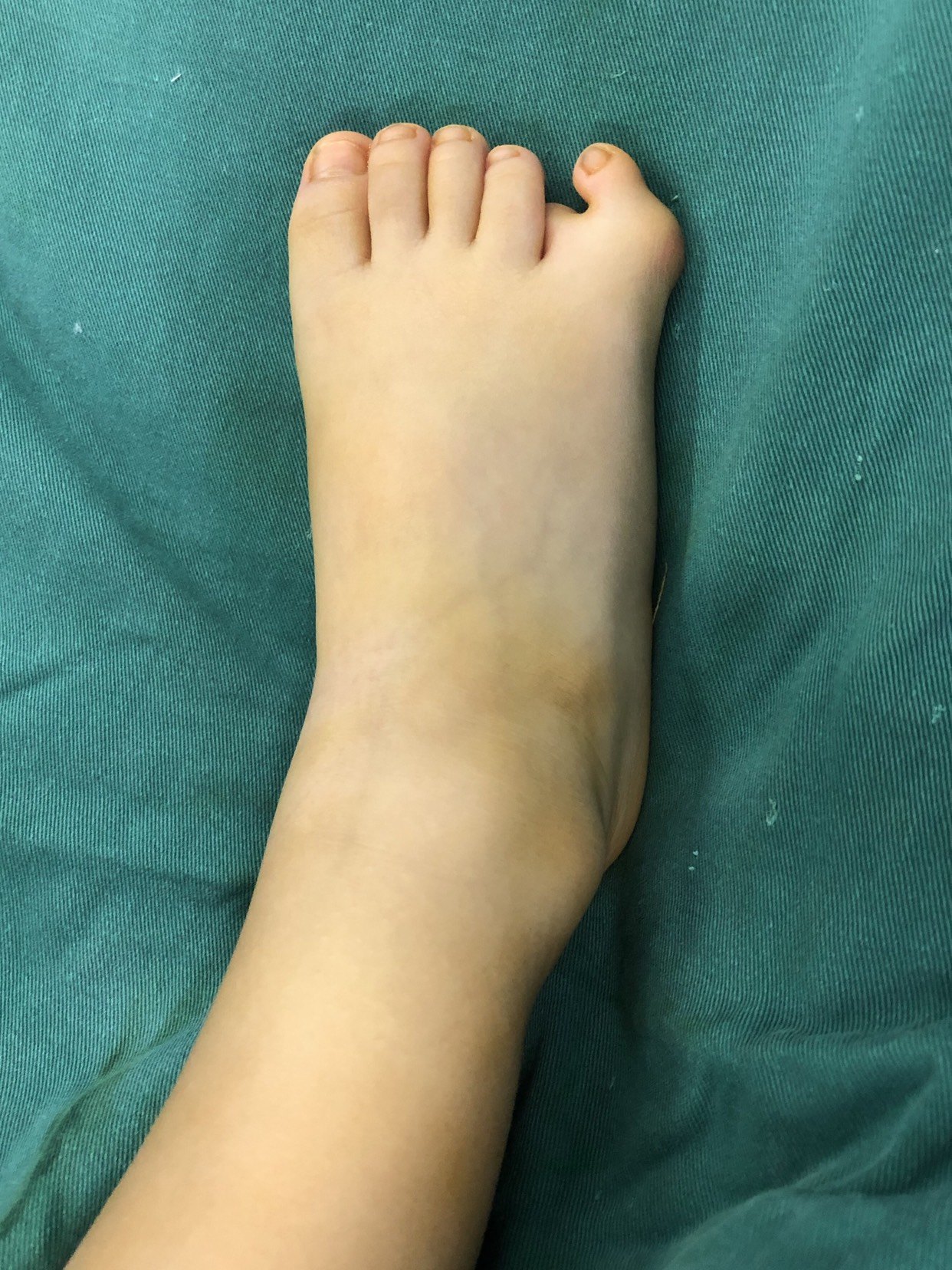 足部并趾畸形整形处理 - 好大夫在线