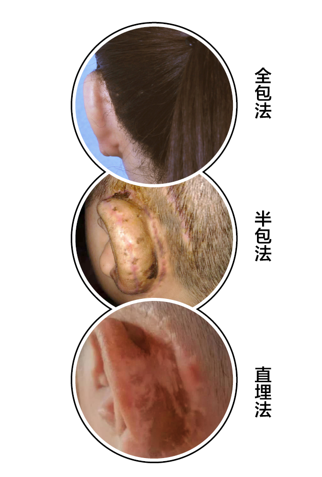 居中,一次成型(筋膜瓣加植皮 疤痕 最明显.