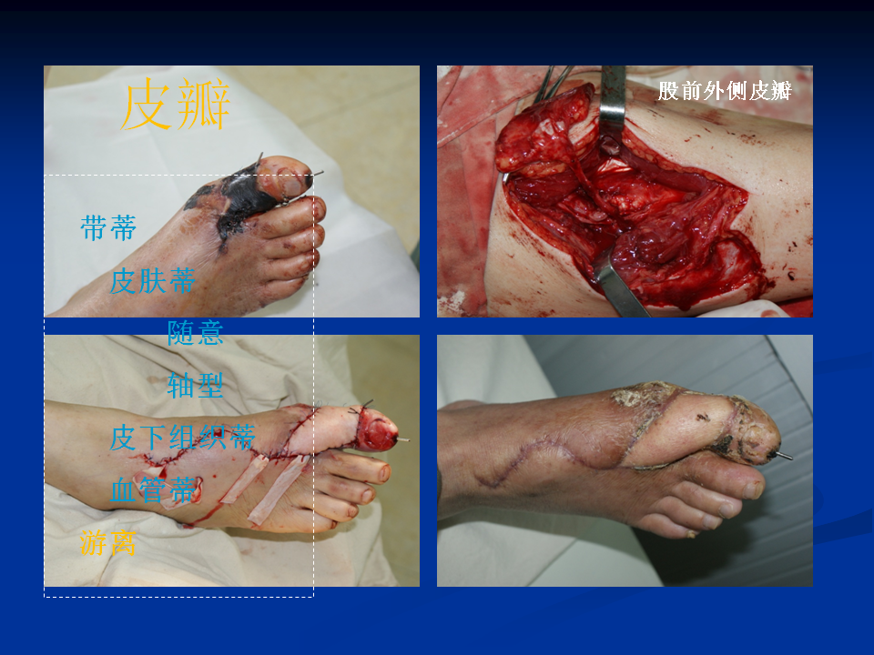 皮肤移植基本概念 - 好大夫在线