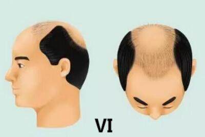 7级是男性雄激素性秃发的严重形式,除马蹄形脱发外,耳周和枕部出现