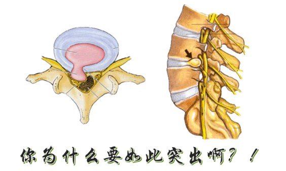 腰椎间盘突出症的自我诊断_腰椎间盘突出_症状_症状表现 - 好大夫在线