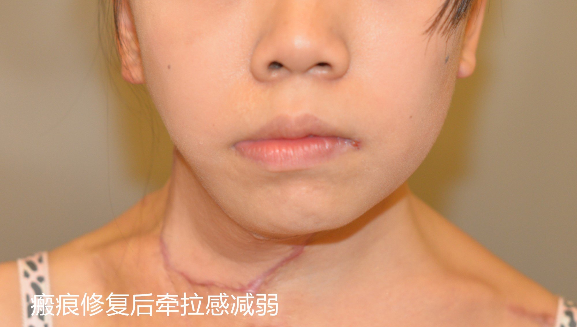 【瘢痕修复案例】瘢痕修复之神奇的——扩张器 - 好大夫在线