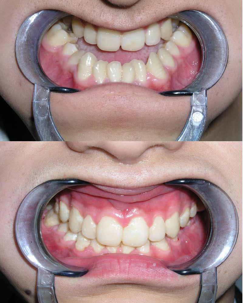 反颌畸形的外科治疗 - 好大夫在线