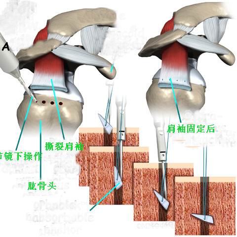 什么是肩关节镜?