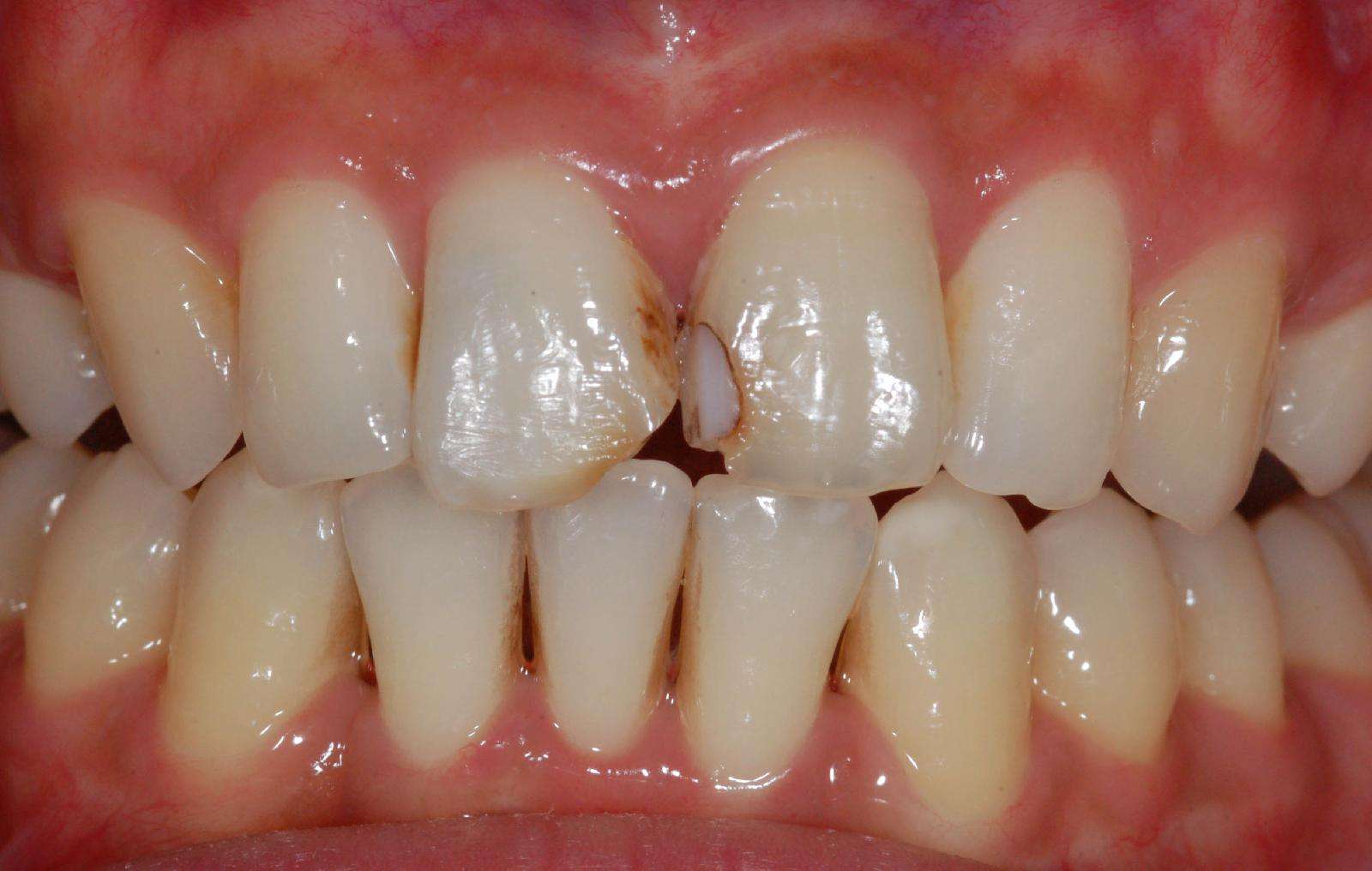 门牙龋齿图片图片