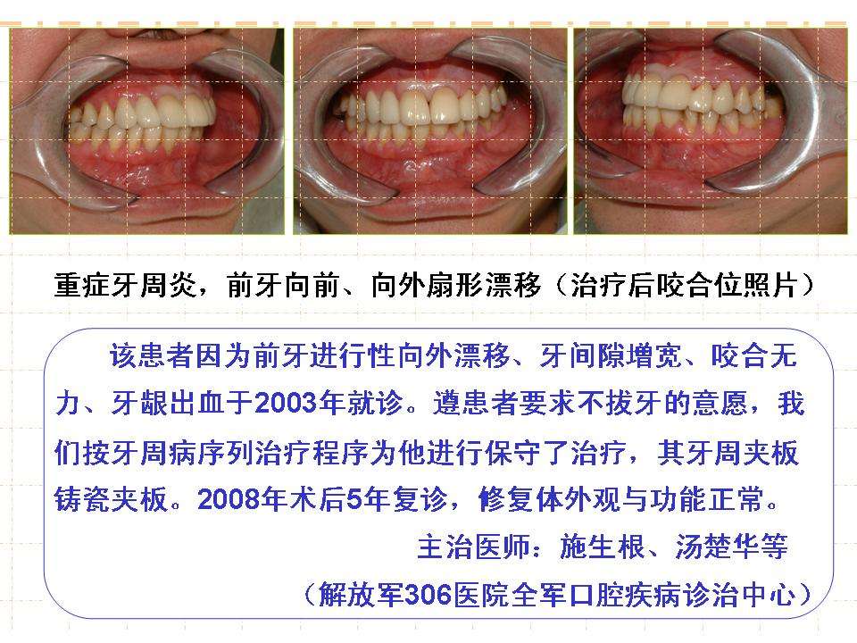 重症牙周炎牙齿扇形漂移及其治疗