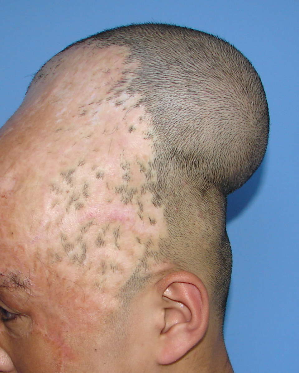 头皮扩张治疗头皮疤痕或秃发 - 好大夫在线