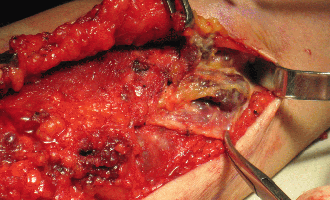 蔓状血管瘤 - 好大夫在线