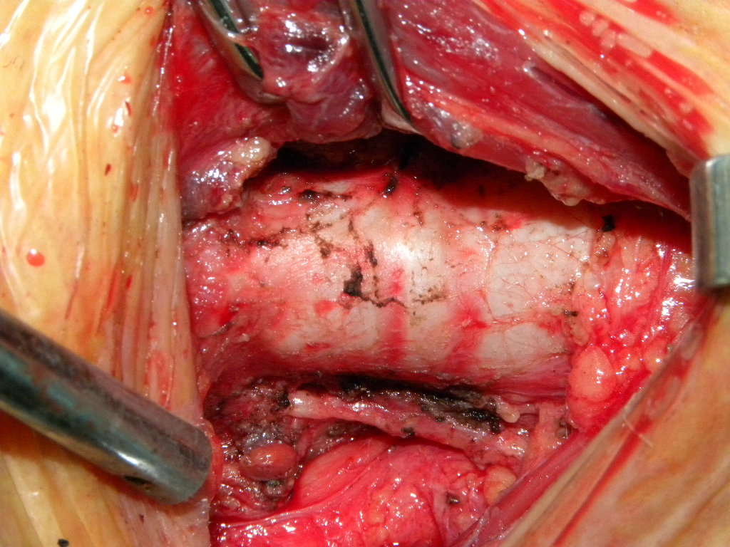 甲状腺结节手术喉返神经显露