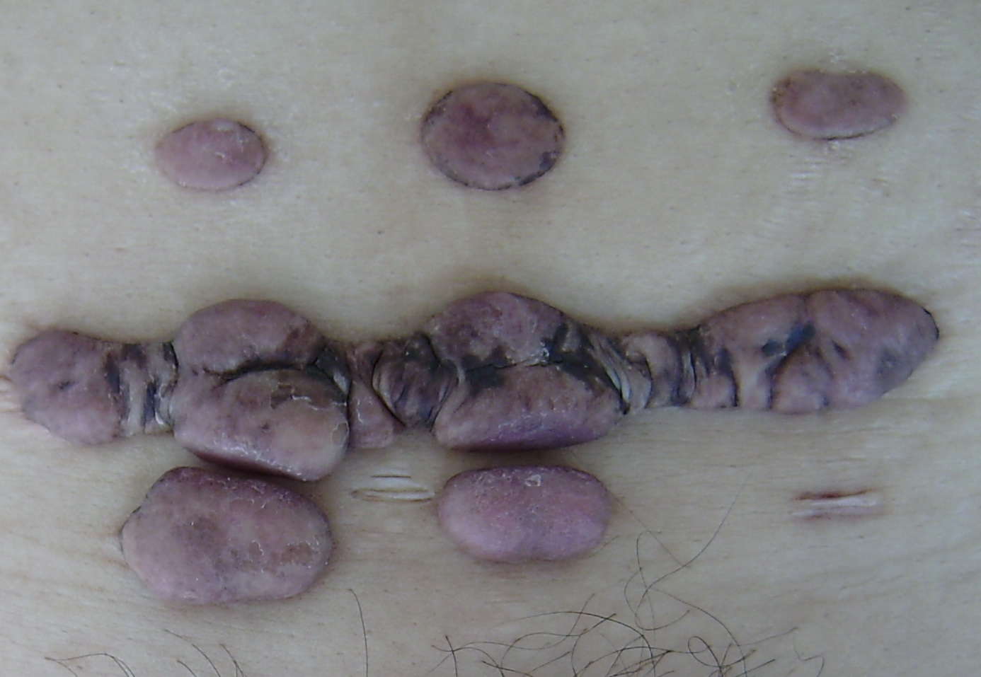 你了解瘢痕疙瘩吗?(附临床病例图片) - 好大夫在线