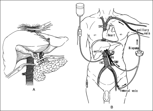 肝癌合併門靜脈癌栓或肝靜脈癌栓的處理