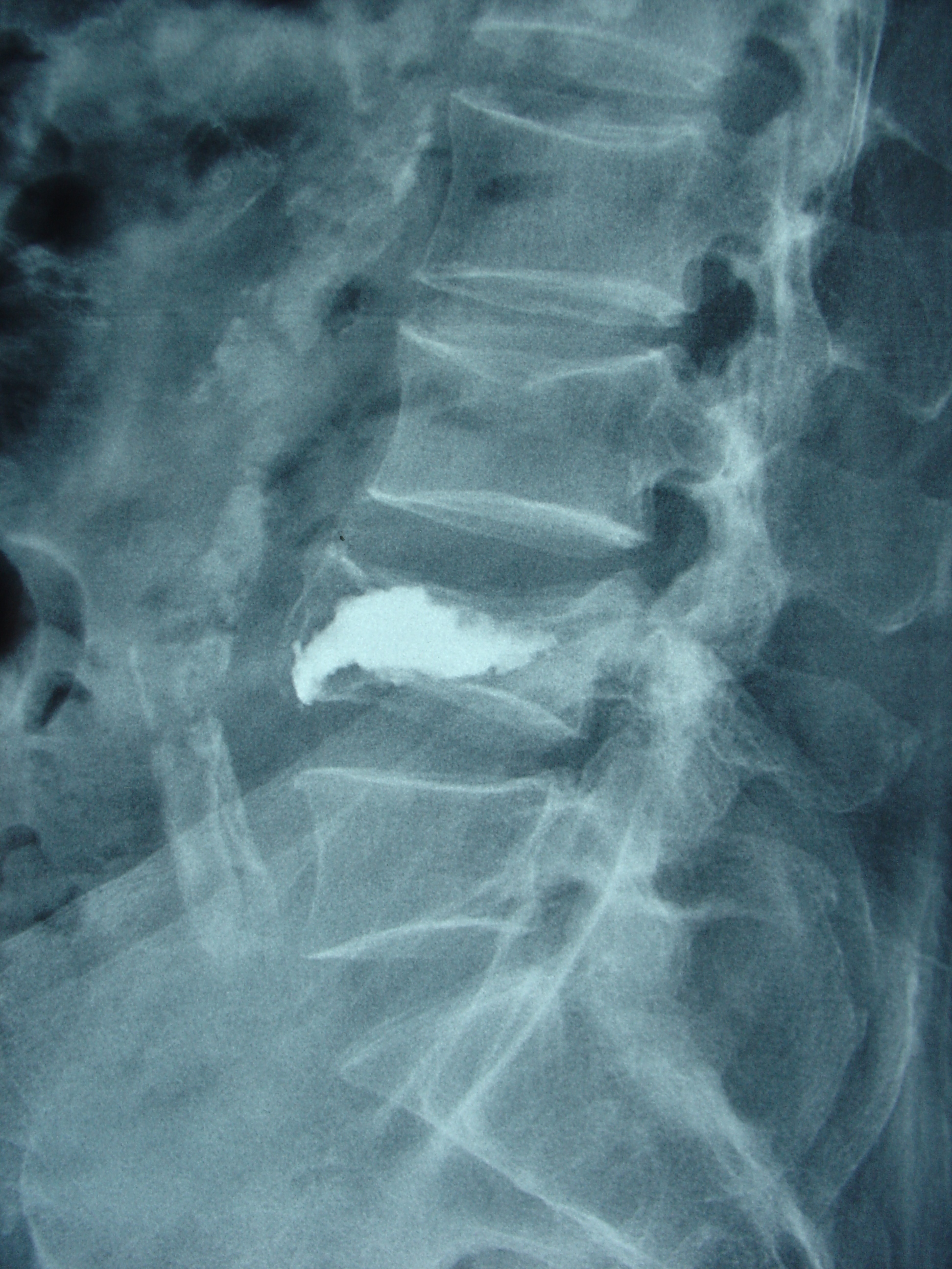 骨质疏松性椎体压缩性骨折——经皮球囊扩张椎体后凸成形术(pkp) - 好