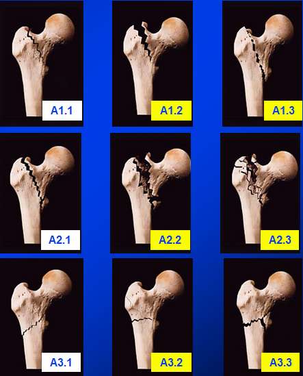 微创治疗股骨转子间骨折病例1 