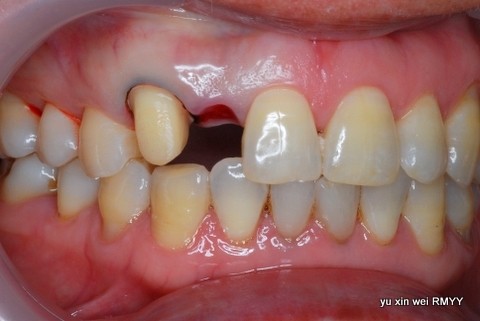 技师制作 美学全瓷冠试戴lava 氧化锆 内冠拆除旧修复体 排龈 牙体