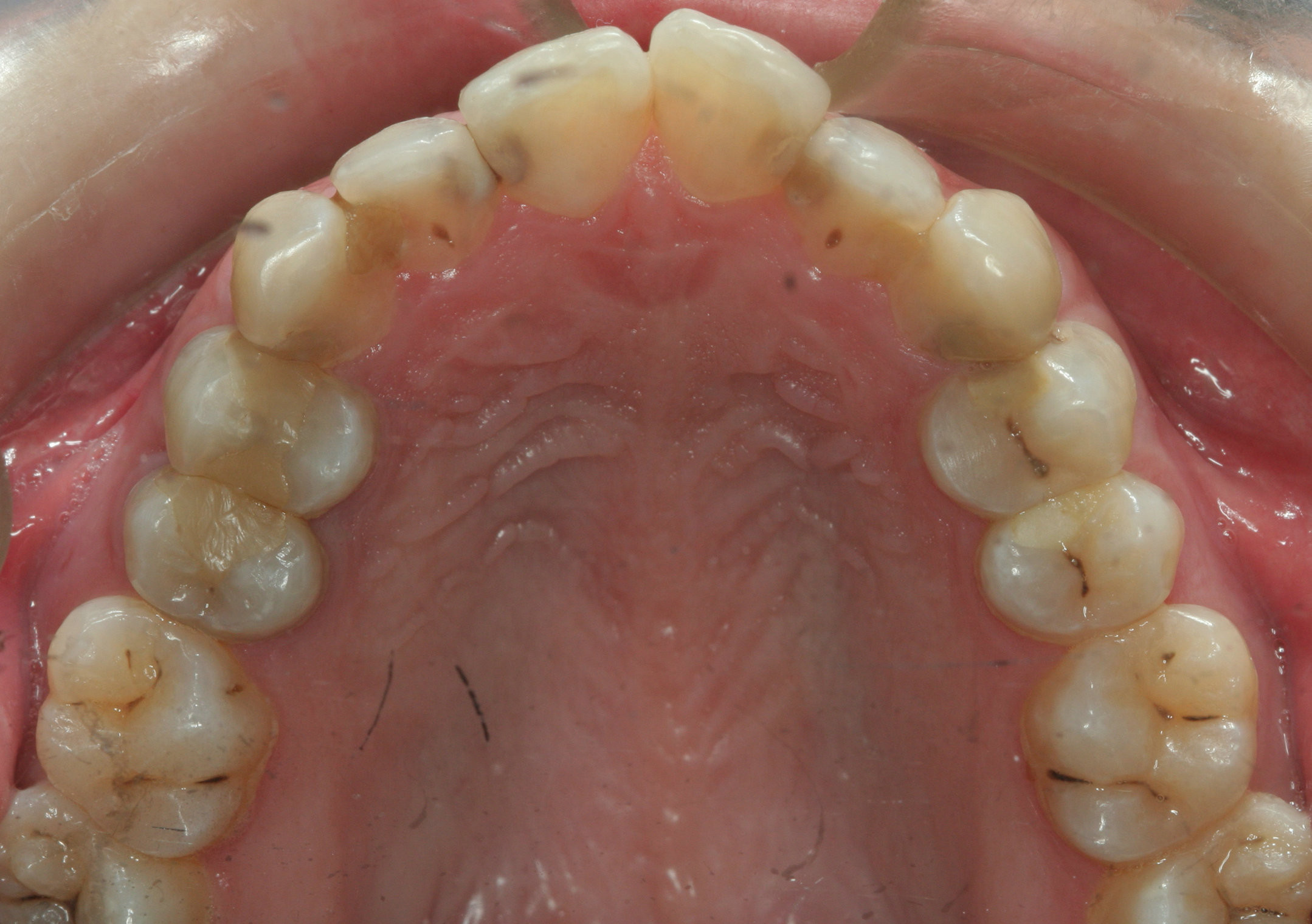谈谈将牙齿磨小进行矫正_牙颌畸形_用药_治疗方式 - 好大夫在线