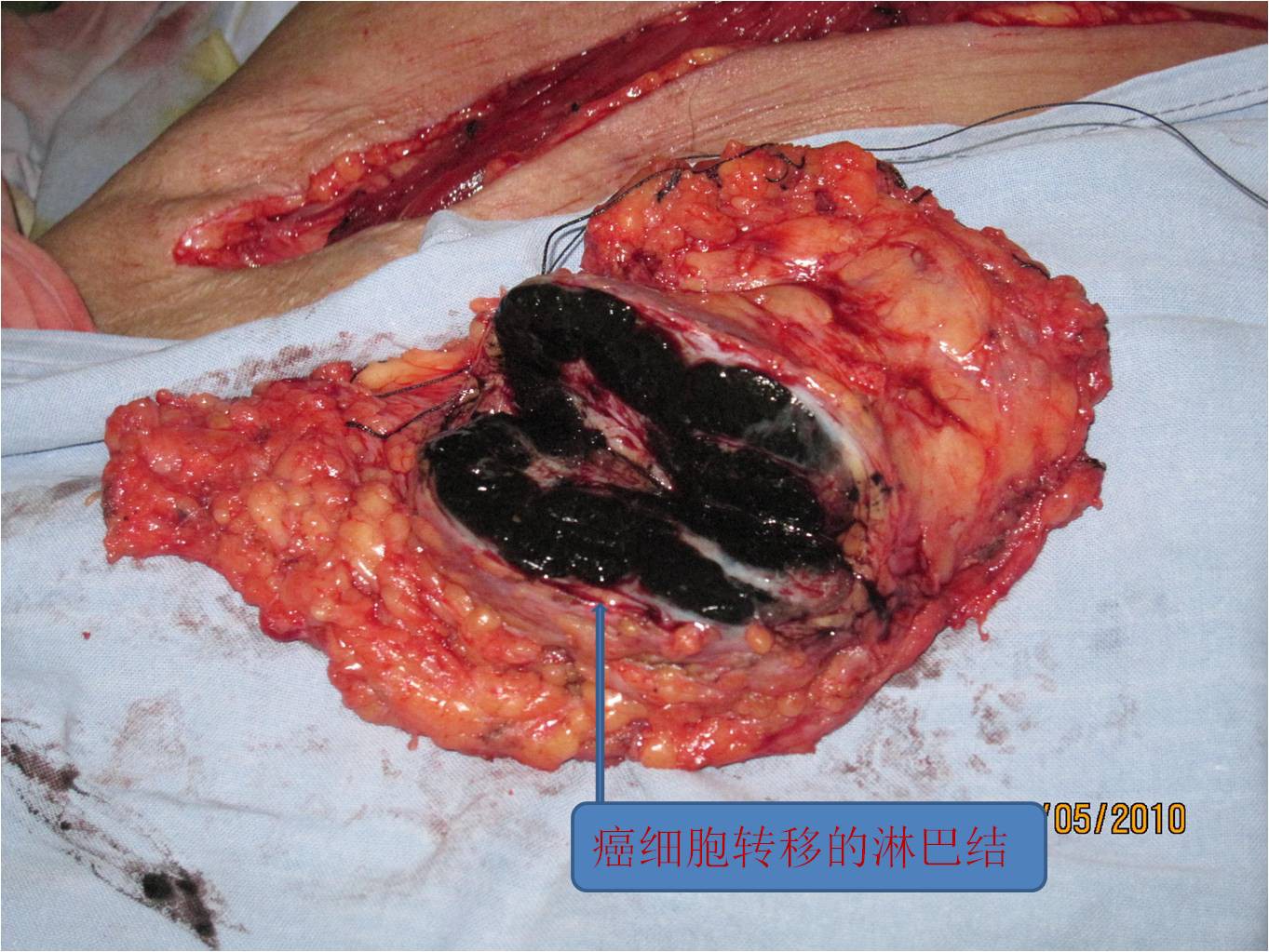 淋巴癌病死率_淋巴癌死亡率_淋巴癌死亡率有多高实话实说