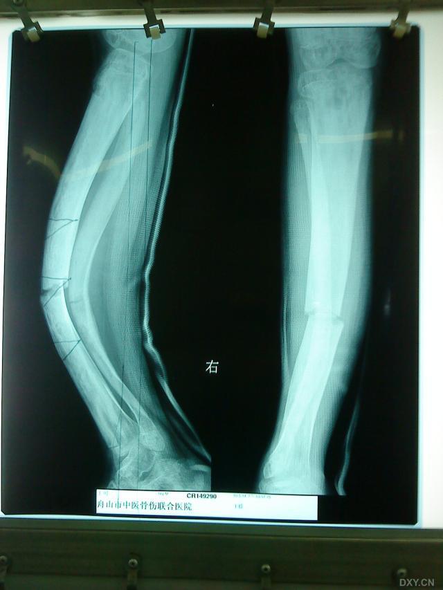 骨纤维异常增殖症(fibrous dysplasia of bone) - 好大夫在线
