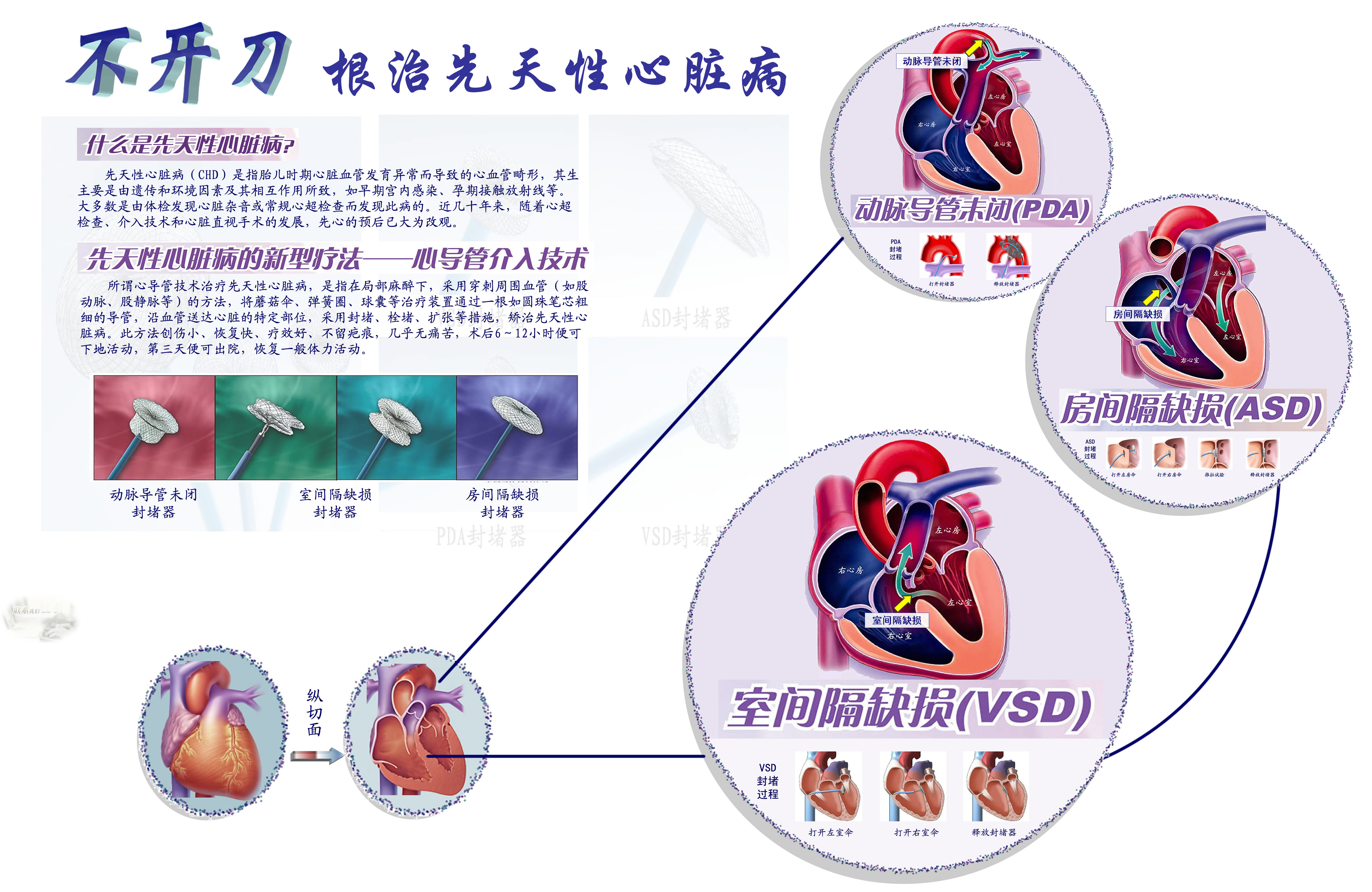 先天性心脏病介入治疗
