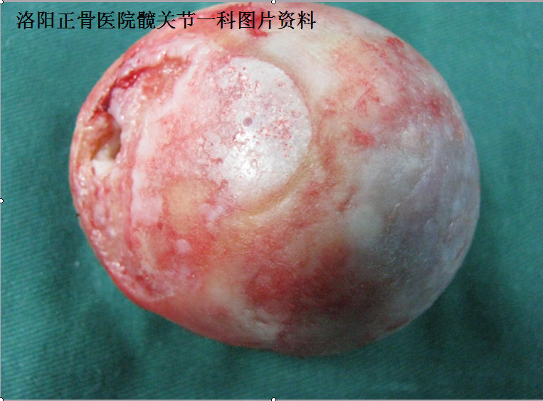 双侧髋臼发育不良