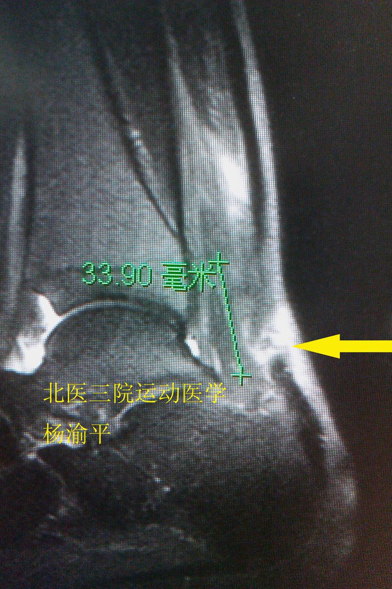 跟腱断裂ct图图片